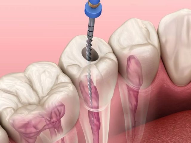 Điều trị tuỷ răng ở Vinh – Top các địa chỉ uy tín (2024)