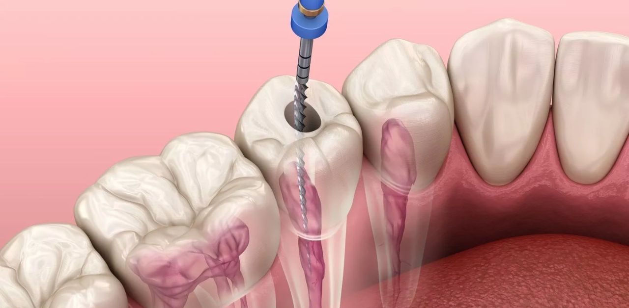 Điều trị tuỷ răng ở Vinh – Top các địa chỉ uy tín (2024)