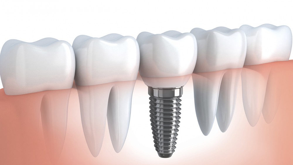 Tại sao nên cắm ghép implant cho răng?