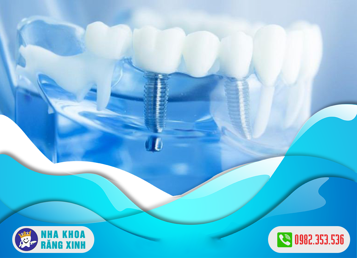 Cắm ghép implant tại TP Vinh an toàn