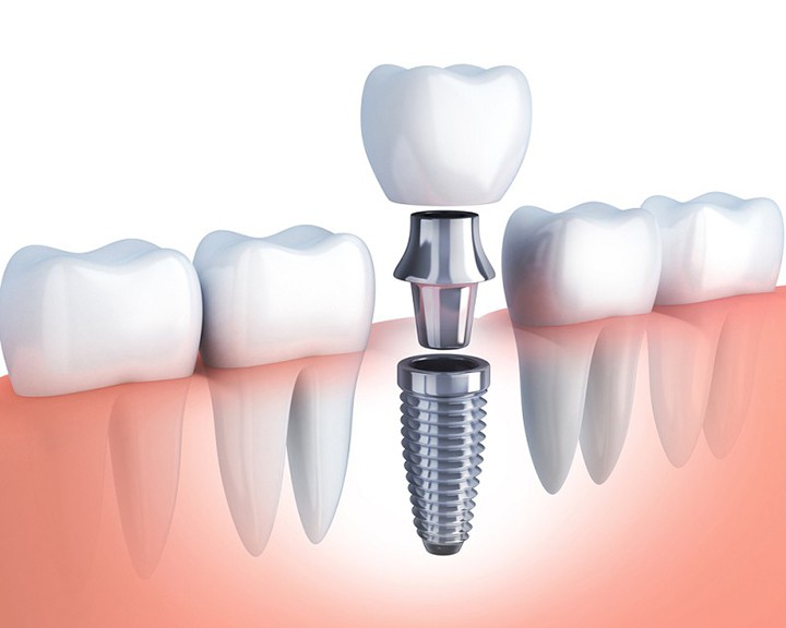 Cắm ghép implant tại TP Vinh uy tín