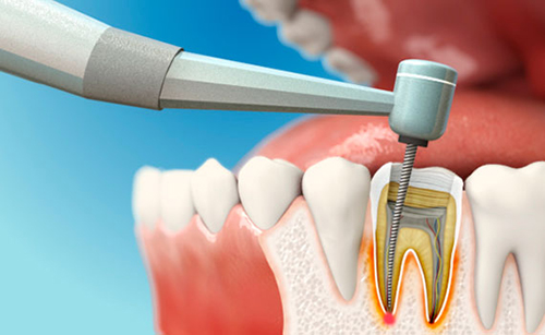 Điều trị tuỷ răng có đau không?