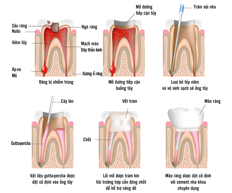 Quy trình chữa viêm tuỷ răng